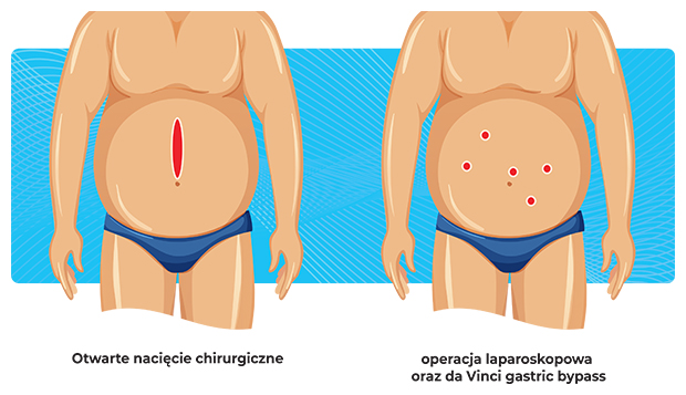 Metody wykonywania zabiegów bariatrycznych da vinci