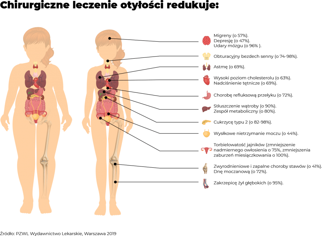 Korzyści z operacji bariatrycznych