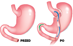 gastric bypass chirurgiczna metoda leczenia otyłości