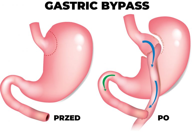 Gastric Bypass metoda operacji bariatrycznej operacje leczenia otyłości