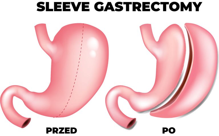 sleeve gastrectomy