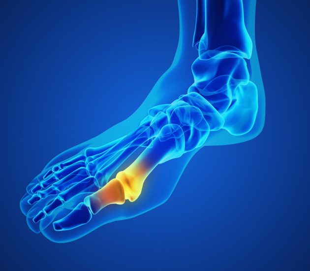 Painful gout inflammation on big toe joint