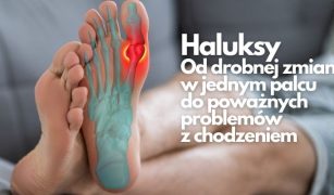 Haluksy. Od drobnej zmiany w jednym palcu do poważnych problemów z chodzeniem (1)