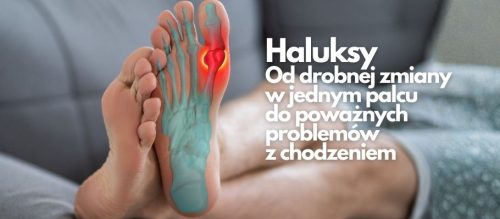 Haluksy. Od drobnej zmiany w jednym palcu do poważnych problemów z chodzeniem (1)