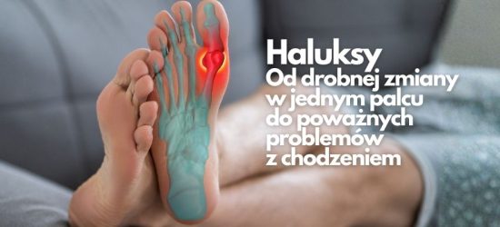 Haluksy. Od drobnej zmiany w jednym palcu do poważnych problemów z chodzeniem (1)
