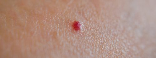 czerwone-jak-rubiny-skad-biora-sie-plamki-rubinowe-i-czy-powinny-nas-martwic-1