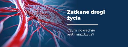 czym-dokladnie-jest-miazdzyca-1