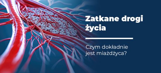 czym-dokladnie-jest-miazdzyca-1