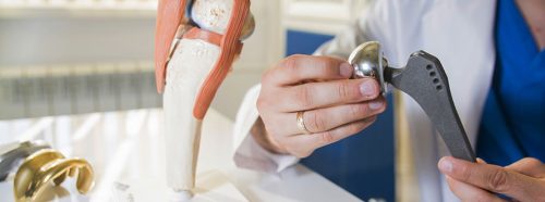 endoprotezoplastyka-stawu-kiedy-zabieg-jest-konieczny