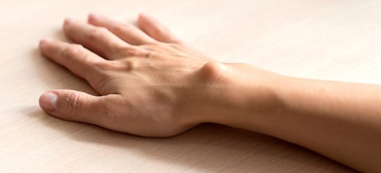 ganglion-czym-jest-jak-sie-objawia-i-jak-go-leczyc-1
