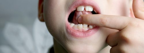 gdy-jezyk-nie-moze-mowic-swobodnie-czym-jest-podciecie-wedzidelka-podjezykowego-1