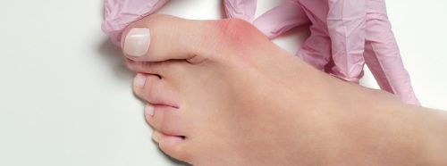 haluksy-dlaczego-powstaja-i-jak-je-leczyc-1