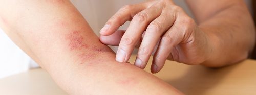 kiedy-ospa-wietrzna-wraca-wszystko-o-polpascu-1