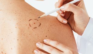laser-czy-skalpel-najskuteczniejsze-sposoby-na-usuniecie-pieprzykow-1