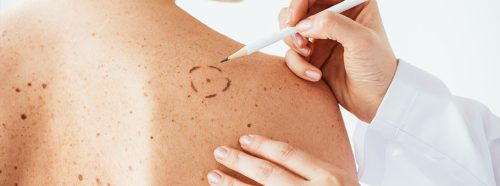 laser-czy-skalpel-najskuteczniejsze-sposoby-na-usuniecie-pieprzykow-1