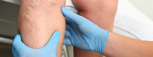 nogi-bez-zylakow-poznaj-metode-rfitt-celon-1