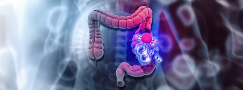 operacyjne-leczenie-raka-jelita-grubego-1
