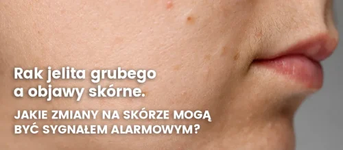 rak-jelita-a-objawy-skorne