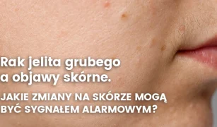 rak-jelita-grubego-a-objawy-skorne