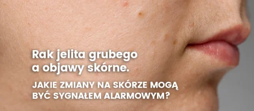 rak-jelita-grubego-a-objawy-skorne