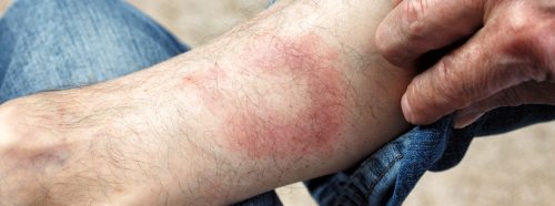 rumien-wedrujacy-czym-jest-i-jak-sobie-z-nim-radzic-1