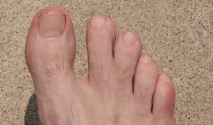 syndaktylia-palcozrost-skad-sie-bierze-i-jak-sie-leczy-1