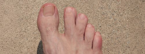 syndaktylia-palcozrost-skad-sie-bierze-i-jak-sie-leczy-1