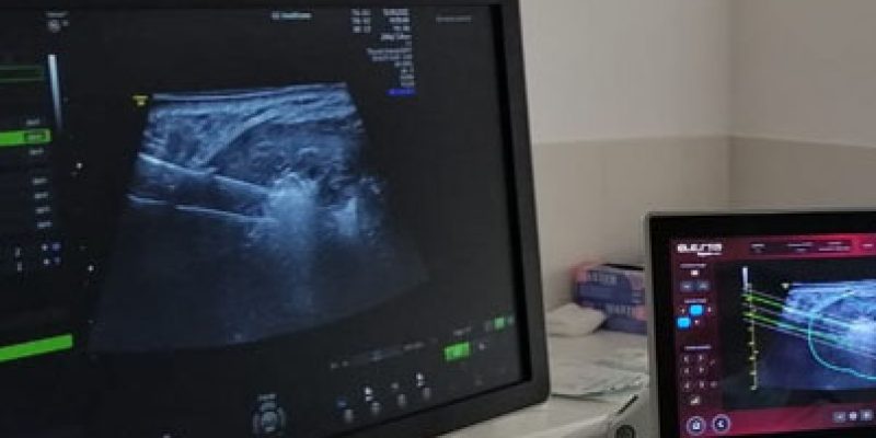 szpital-na-klinach-w-czolowce-polskich-osrodkow-specjalizujacych-sie-w-leczeniu-lagodnych-guzkow-tarczycy-z-wykorzystaniem-echolasera