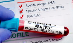 test-psa-proste-badanie-wielkie-znaczenie-co-powinienes-wiedziec-o-kluczowym-badaniu-w-diagnostyce-schorzen-prostaty-1