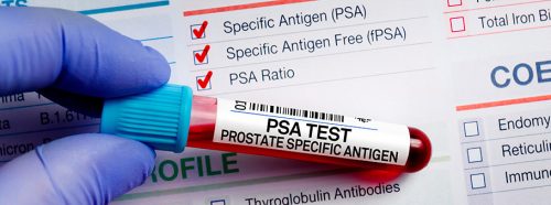 test-psa-proste-badanie-wielkie-znaczenie-co-powinienes-wiedziec-o-kluczowym-badaniu-w-diagnostyce-schorzen-prostaty-1
