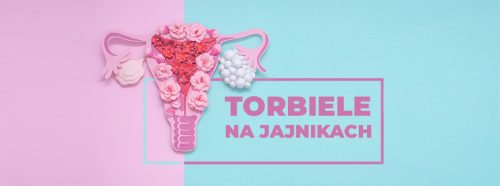 torbiele-na-jajnikach-1