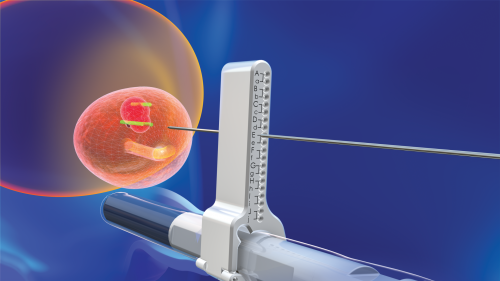 transperineal-biopsy-trinity