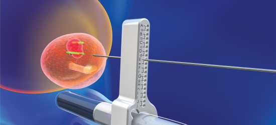 transperineal-biopsy-trinity