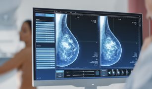 zrazikowy-rak-piersi-objawy-diagnozowanie-leczenie-1