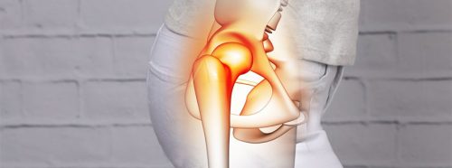 zwyrodnienie-stawu-biodrowego-kiedy-zabieg-endoprotezoplastyki