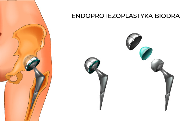 endoprotezoplastyka biodra