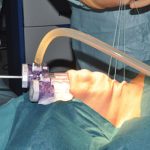 endoskopowa operacja tarczycy metoda toetva
