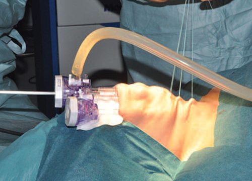 Endoskopowa operacja tarczycy metodą TOETVA 3