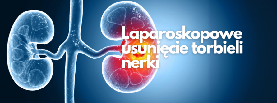 Laparoskopowe usunięcie torbieli nerki laparoskopowe usuniecie torbieli nerki