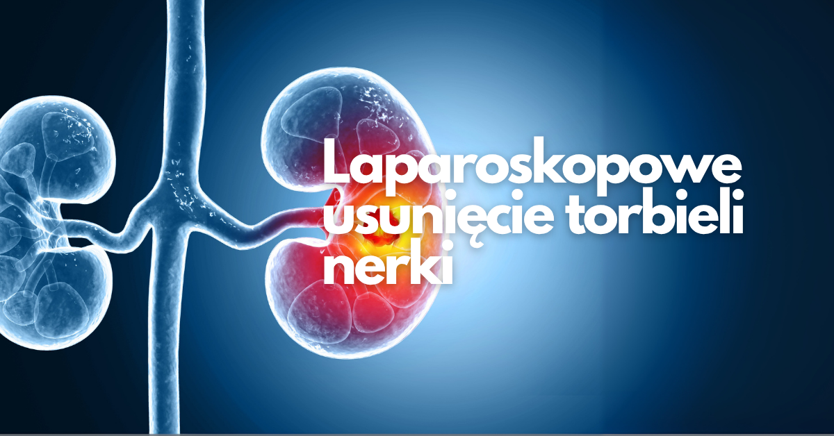 Laparoskopowe usunięcie torbieli nerki