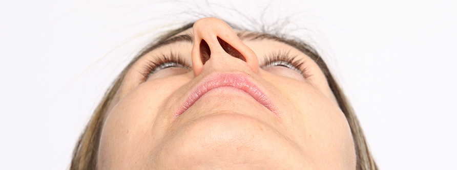 operacyjne leczenie skrzywionej przegrody nosa septoplastyka