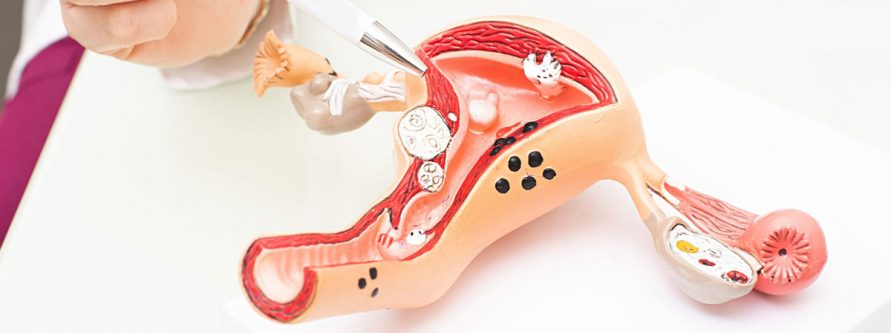 rak endometrium to nie wyrok operacyjne leczenie raka endometrium