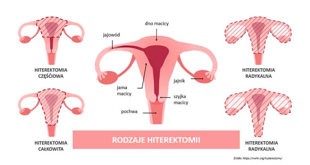 rodzaje histerektomii