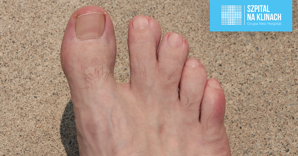 Syndaktylia (palcozrost). Skąd się bierze i jak się leczy?
